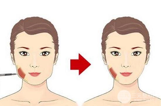 一針改寫(xiě)命運(yùn)，10分鐘打造精致小臉，注射瘦臉價(jià)格奉上~