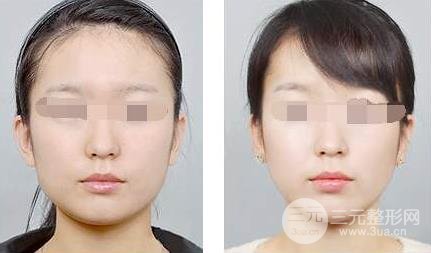 一針改寫(xiě)命運(yùn)，10分鐘打造精致小臉，注射瘦臉價(jià)格奉上~