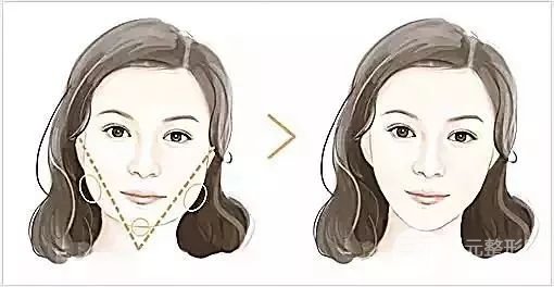 港真！激光溶脂瘦臉會反彈嗎？怎么做可以避免？