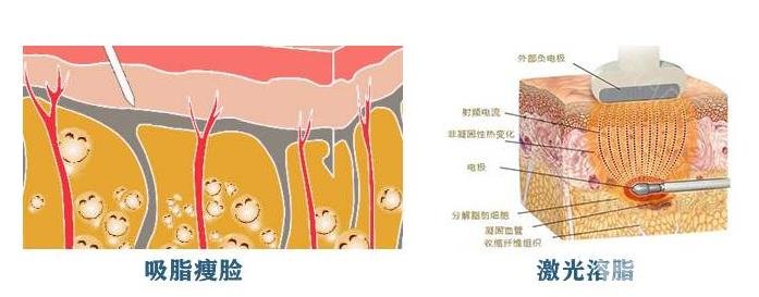 港真！激光溶脂瘦臉會反彈嗎？怎么做可以避免？