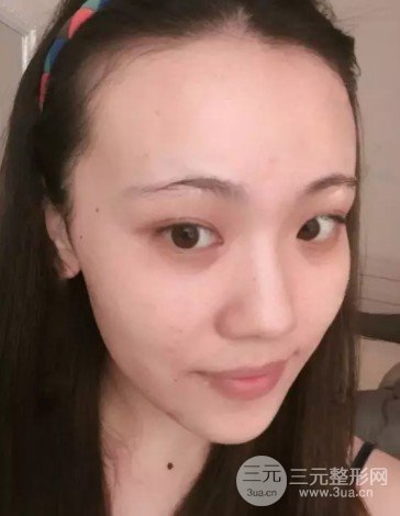 彩光去雀斑需要做幾次