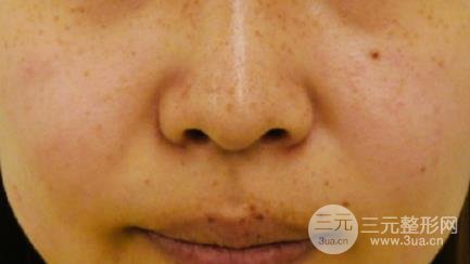 彩光去雀斑需要做幾次