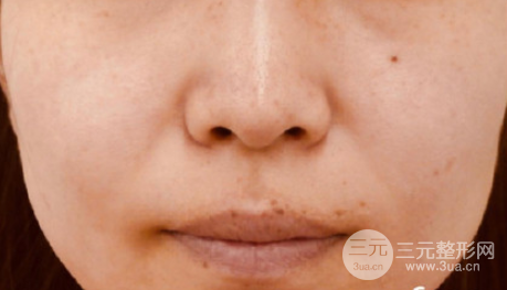 彩光去雀斑需要做幾次