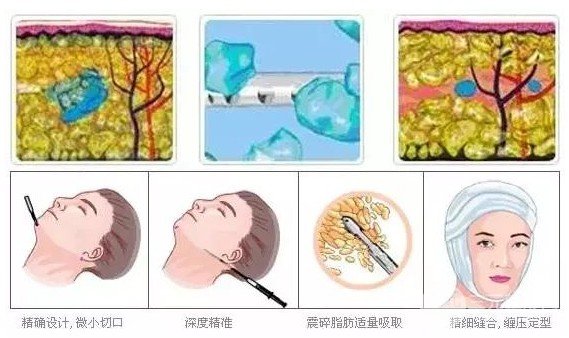 面部光纖溶脂有什么副作用嗎