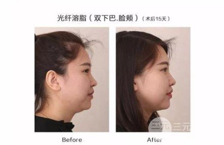 面部光纖溶脂有什么副作用嗎