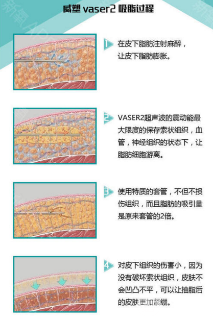 副乳吸脂后多久能看到果