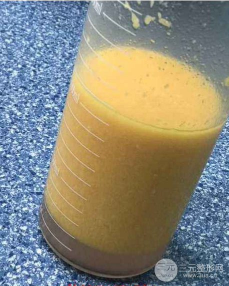 副乳吸脂后多久能看到果