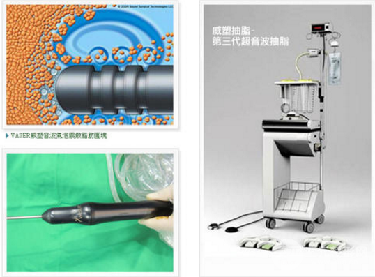 副乳吸脂后多久能看到果