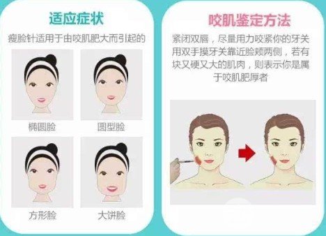 注射瘦臉大概多少錢