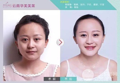 注射瘦臉大概多少錢