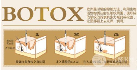 注射****注射瘦臉注意