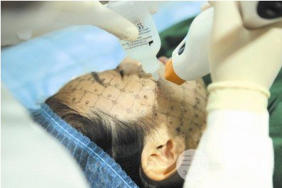 熱瑪吉緊膚除皺適合多大年齡的人做