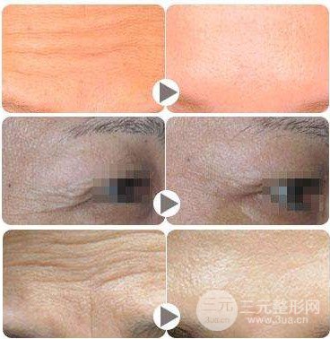 熱瑪吉緊膚除皺適合多大年齡的人做