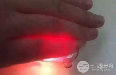 隆鼻硅膠假體透光的原因