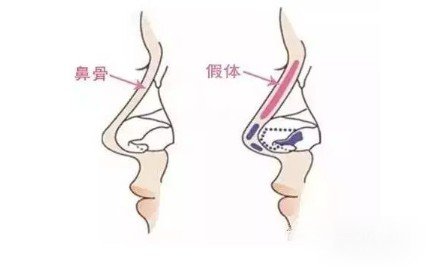 隆鼻硅膠假體透光的原因