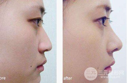 隆鼻硅膠假體透光的原因