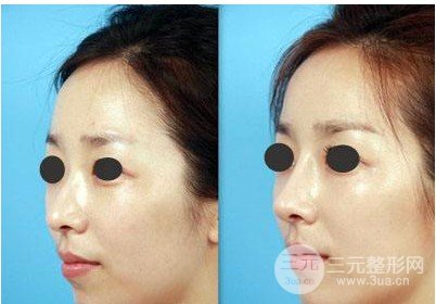 隆鼻硅膠假體透光的原因