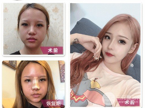 假體隆鼻會變形嗎