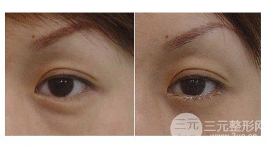 抽脂去除眼袋降低風險嗎