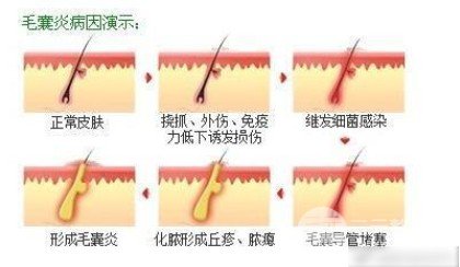 杭州市一醫(yī)院植發(fā)案例