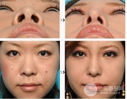 鼻翼縮小術(shù)費(fèi)用