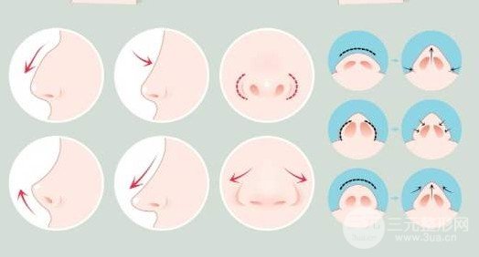 鼻翼縮小術(shù)費(fèi)用