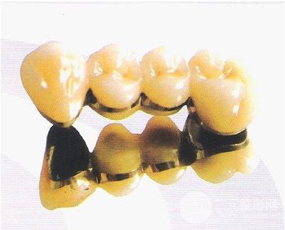 烤瓷牙種類及價(jià)格