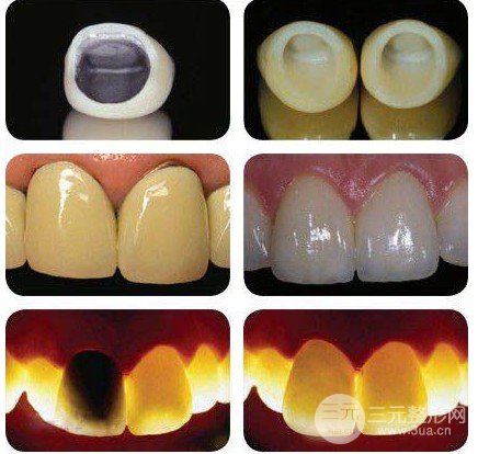 烤瓷牙種類及價(jià)格