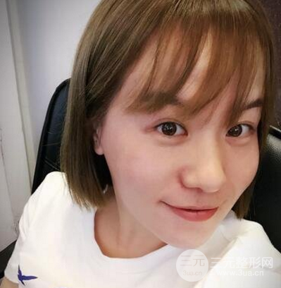 面部溶脂前后對比照片