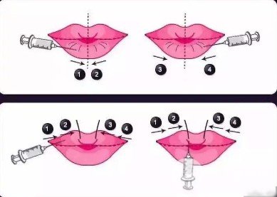 玻尿酸豐唇多少錢一針