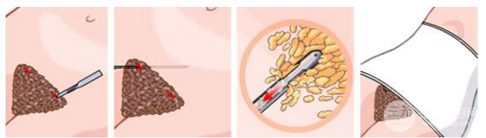 2019年腰部吸脂減肥價(jià)格一覽表 附抽脂圖