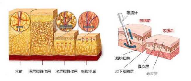2019年腰部吸脂減肥價(jià)格一覽表 附抽脂圖