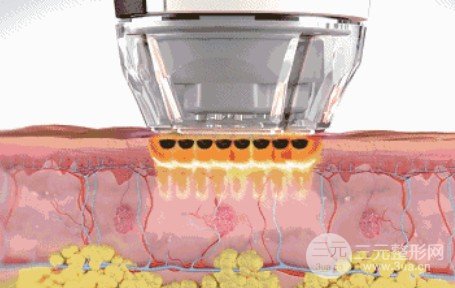 光子嫩膚面部皺紋成好嗎