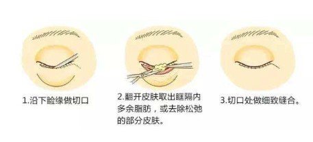 眼袋大別做內(nèi)切祛眼袋