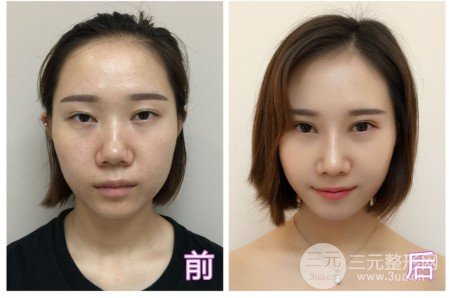 鼻尖整形需要多少錢