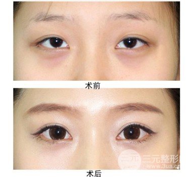 開大眼角手術(shù)果對比圖