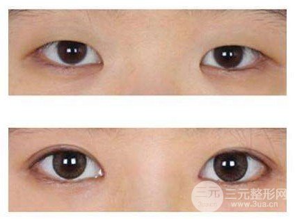 開大眼角手術(shù)果對比圖