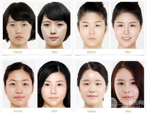 開大眼角手術(shù)果對比圖