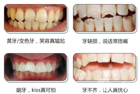 全瓷烤瓷牙價格