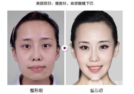 注射瘦臉多少錢一針