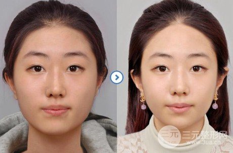 注射瘦臉多少錢一針