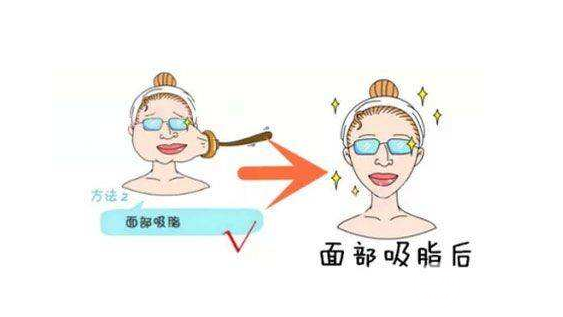 吸脂瘦臉手術(shù)術(shù)后一定要注意這些，別說(shuō)我沒(méi)告訴你！