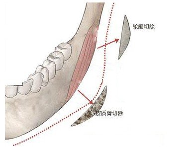 下頜角切除費(fèi)用