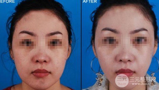 下頜角切除費(fèi)用