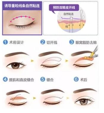 雙眼皮手術(shù)的方式都有哪一些?