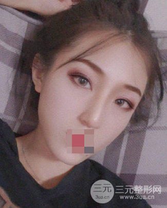 抽脂去眼袋手術(shù)的利弊