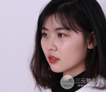 玻尿酸隆鼻對比圖