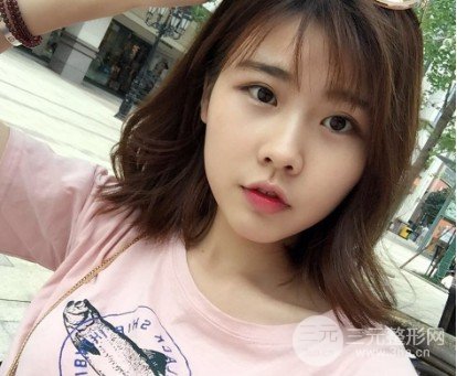 玻尿酸隆鼻對比圖