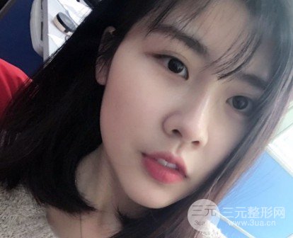 玻尿酸隆鼻對比圖