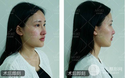 不開(kāi)刀隆鼻是什么技術(shù)